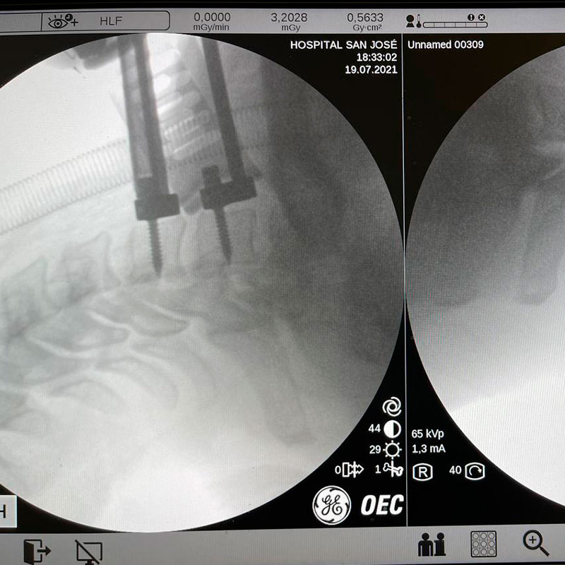 Paciente hernia discal entre la 6ª hernia cercical y la 7ª (Artroplastia)-3