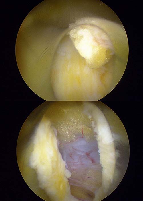 Caso-clinico-Hermia-discal-L5S1