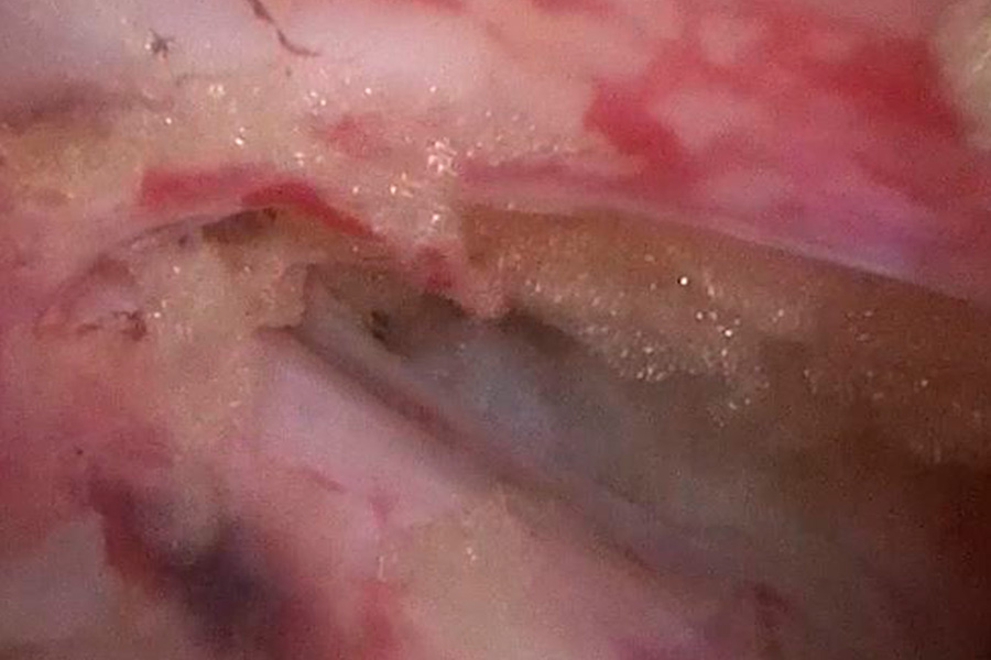 caso clínico Liberación de prótesis lumbar debido a una artroplastia fallida