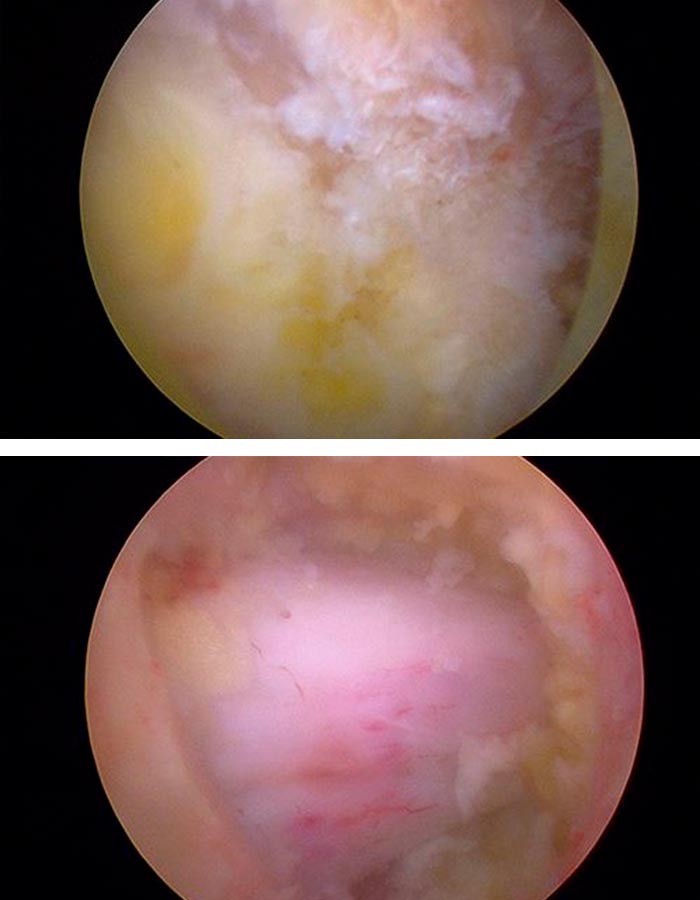 Cirugia endoscopia de columna