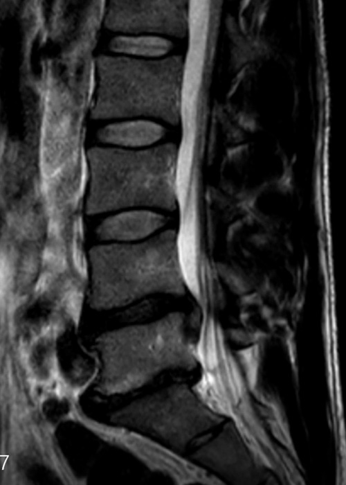 Cirugia avanzada de columna