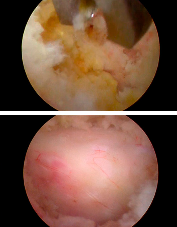 Cirugia de columna para estenosis de canal