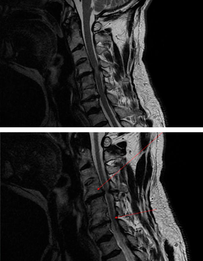cirugia avanzada de columna cervical