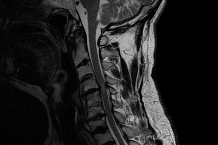 cirugia avanzada de columna cervical