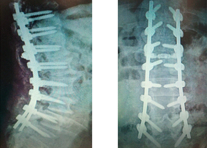 cirugia-de-columna-en-madrid-instituto-cac