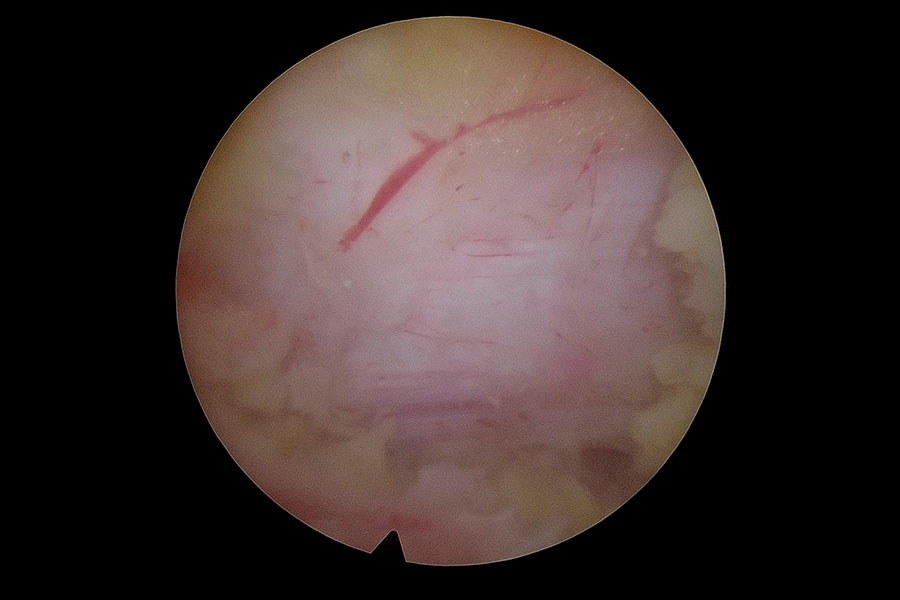 cirugia de columna minimamente invasiva