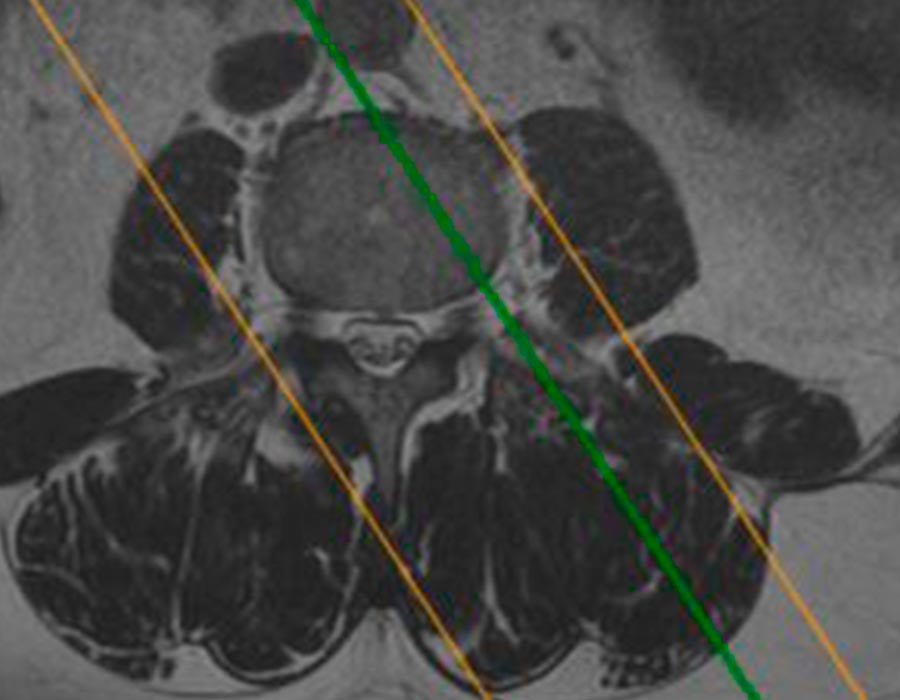 Cirugia endoscopia de columna