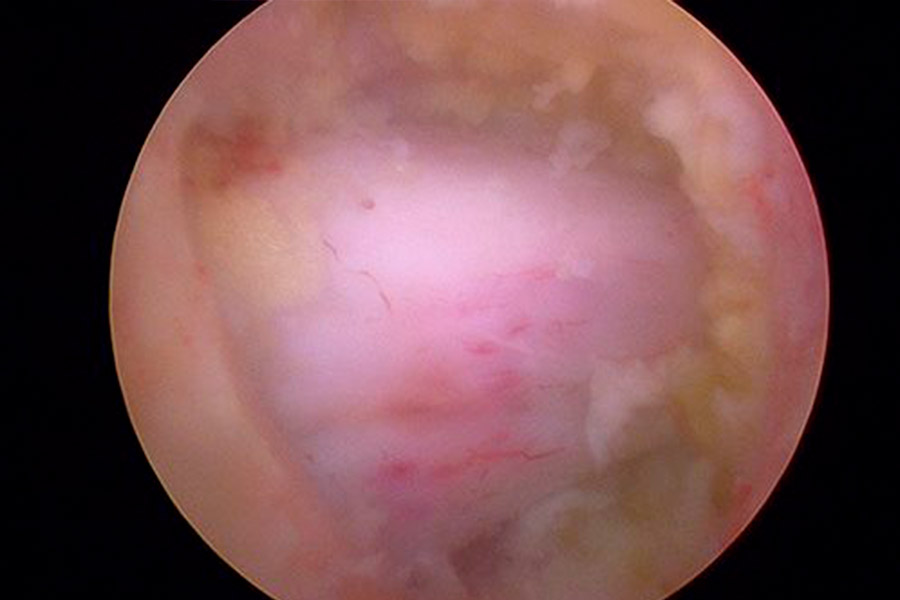Cirugia endoscopia de columna
