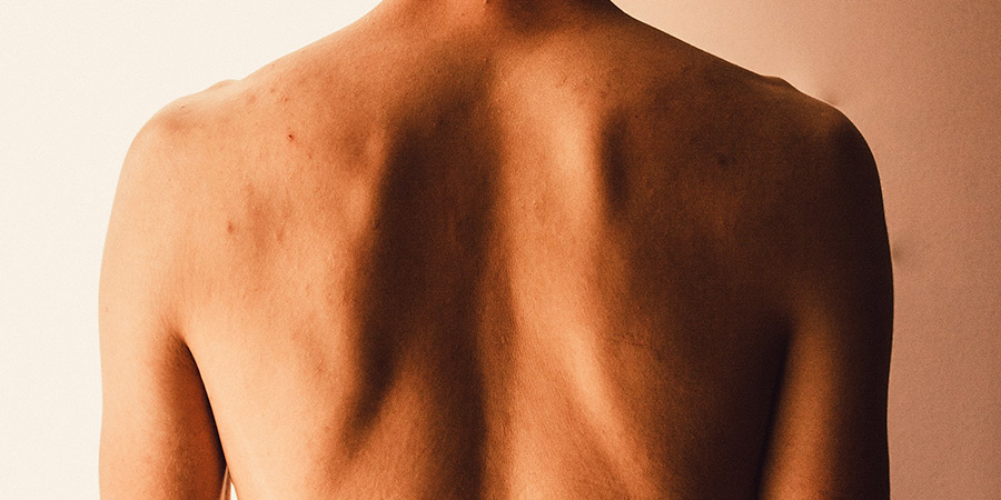 deformaciones-de-la-columna-vertebral-cifosis