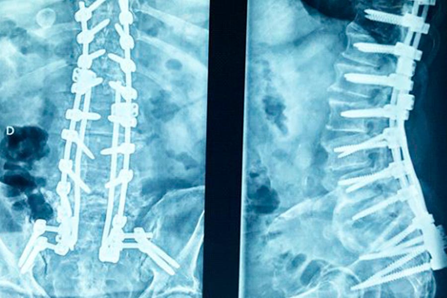 destacada-caso-cirugia-de-columna