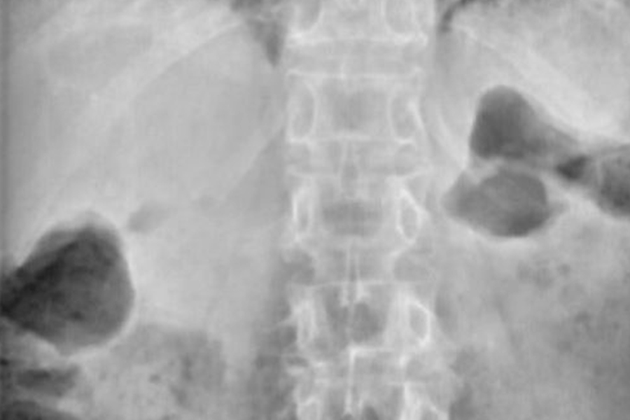 destacada-especialistas-en-cifoplastia-en-madrid