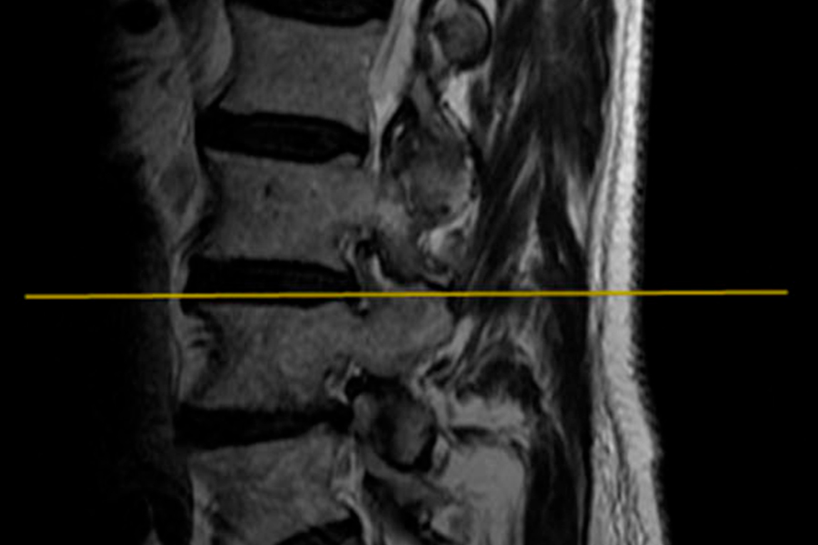 destacada-estenosis-de-canal-instituto-cac