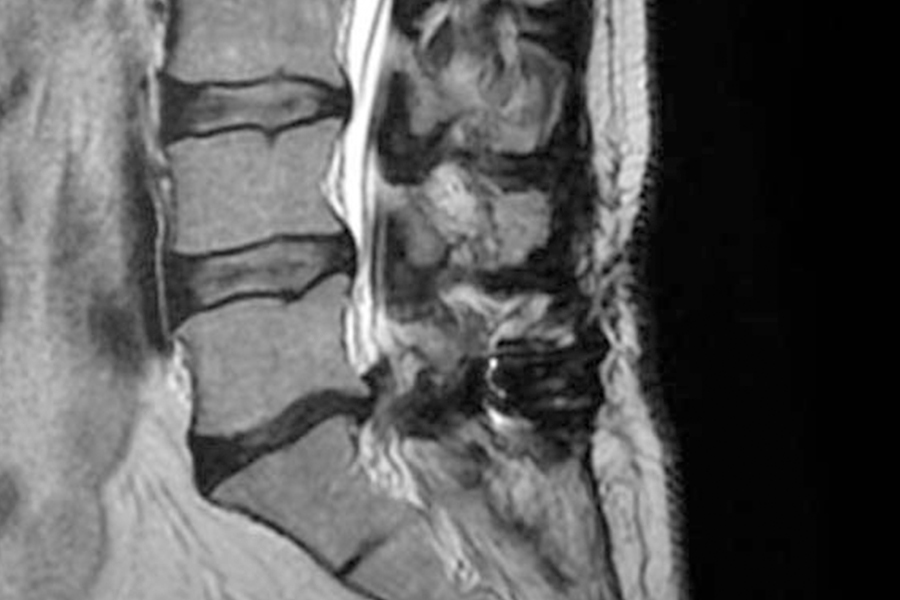 destacada-hernia-discal-instituto-cac-madrid