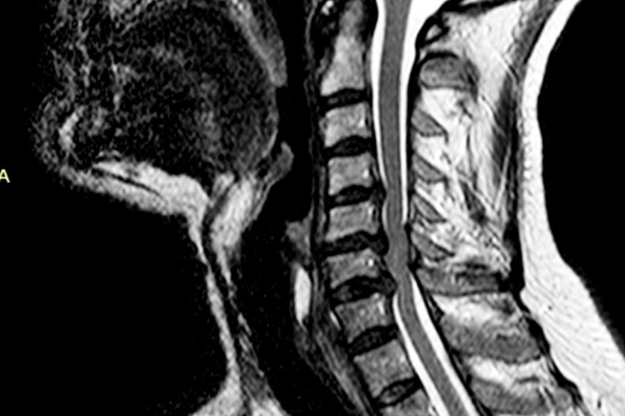 destacada-mielopatia