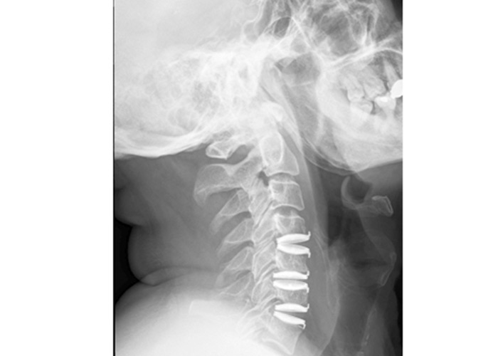disectomia-protesis-cervicales-en-madrid