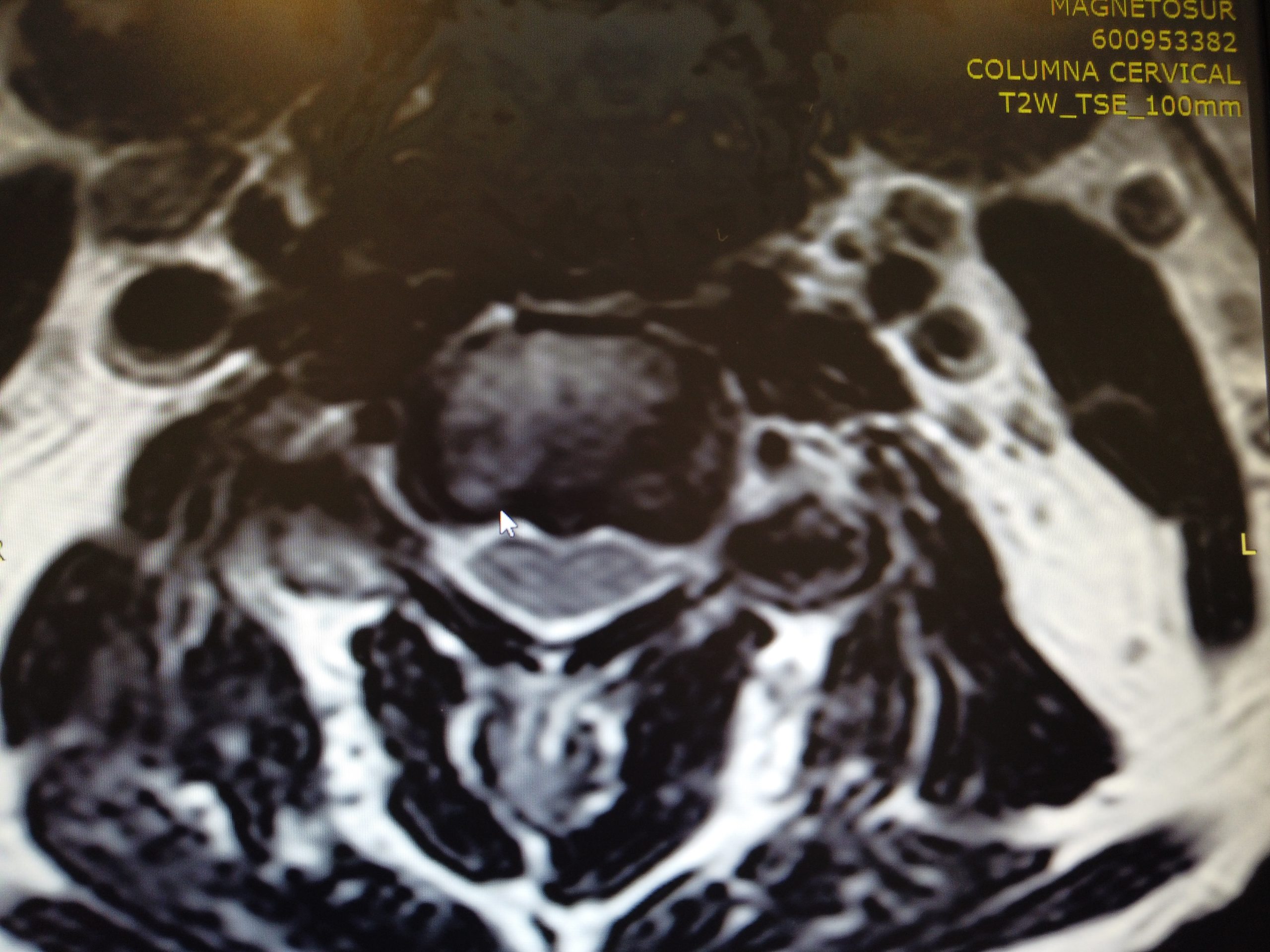 Cirugía de columna mínimamente invasiva mediante endoscopia