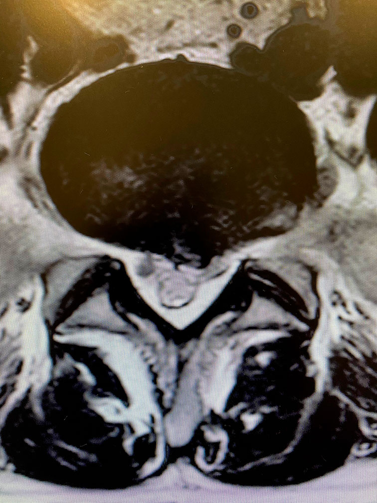 endoscopia de columna avanzada