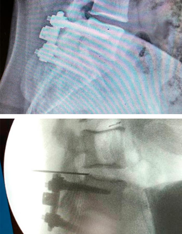 Cirugia endoscopia de columna