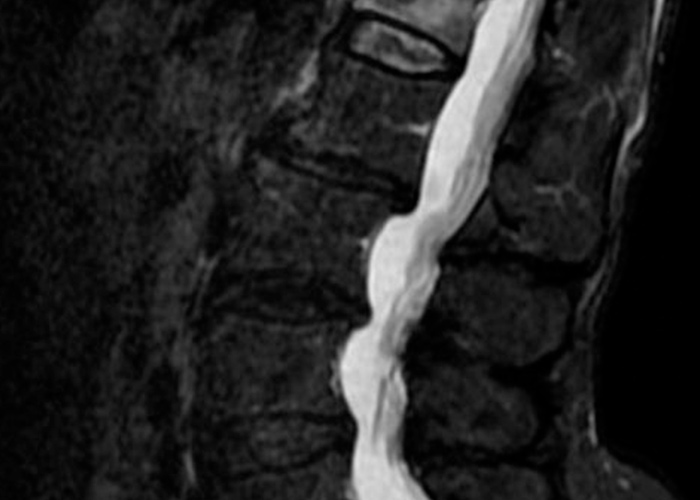 especialistas-en-cifoplastia-madrid