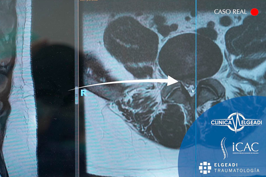 estenosis canal multinivel caso clinico icac