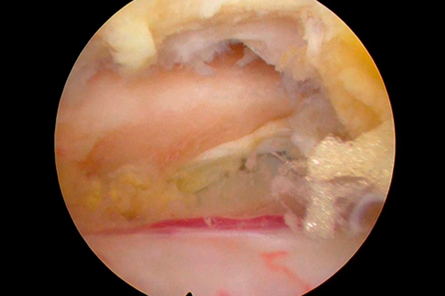 estenosis de canal central