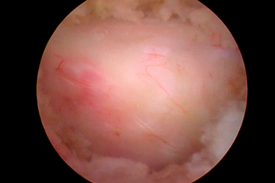 estenosis de canal grave