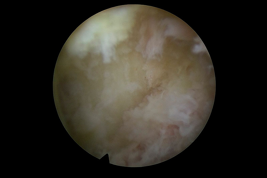 estenosis de canal nivel l4l5l1