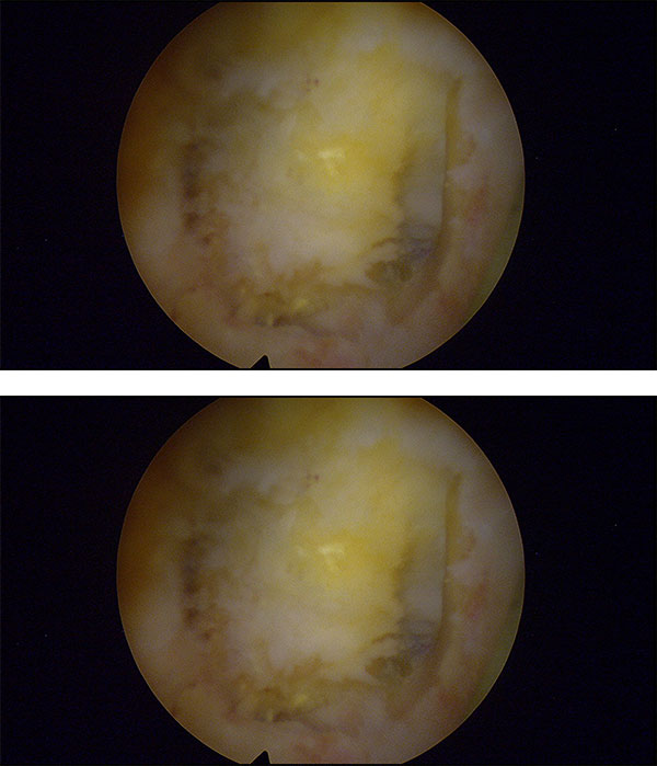 Estenosis de dos niveles operacion