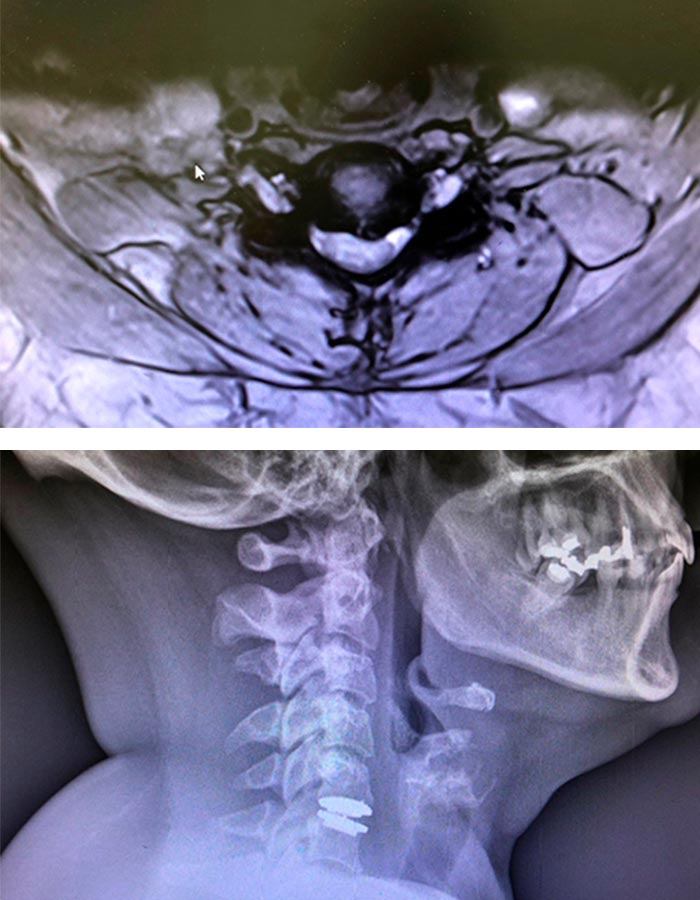 Hernia discal cirugia