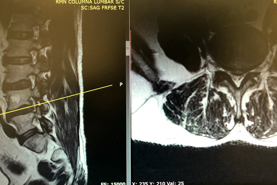 hernia-discal-con-migración-lumbar-icac