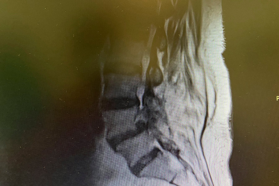 Hernia-discal-foramidal-josefa-carro-post