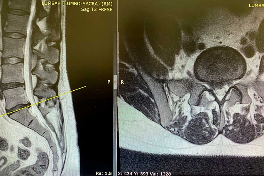 Hernia-discal-L5S1-David-García
