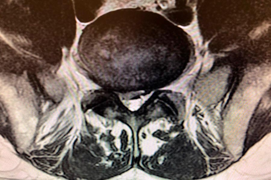 hernia-discal-l5si-lateralizada