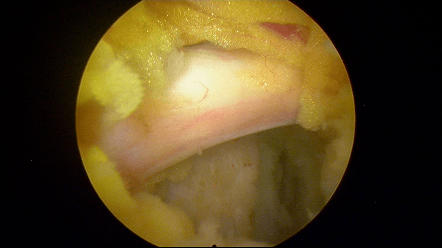 Hernia discal lateral derecho