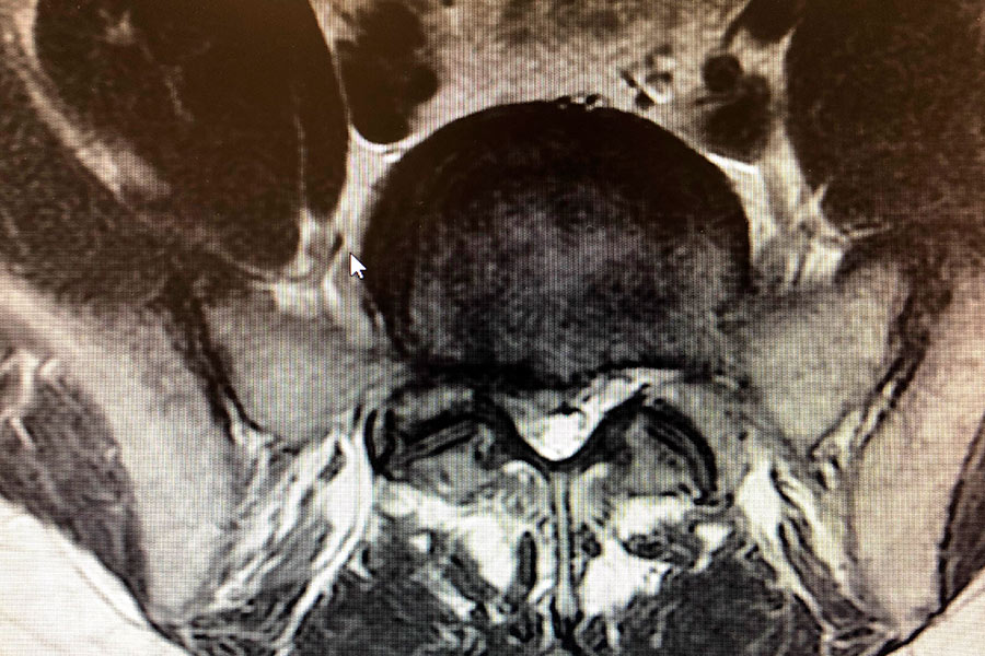 hernia-discal-mononivel-endoscopia-de-columna