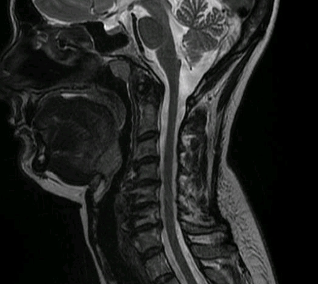 Resonancia magnetica cervical caso real