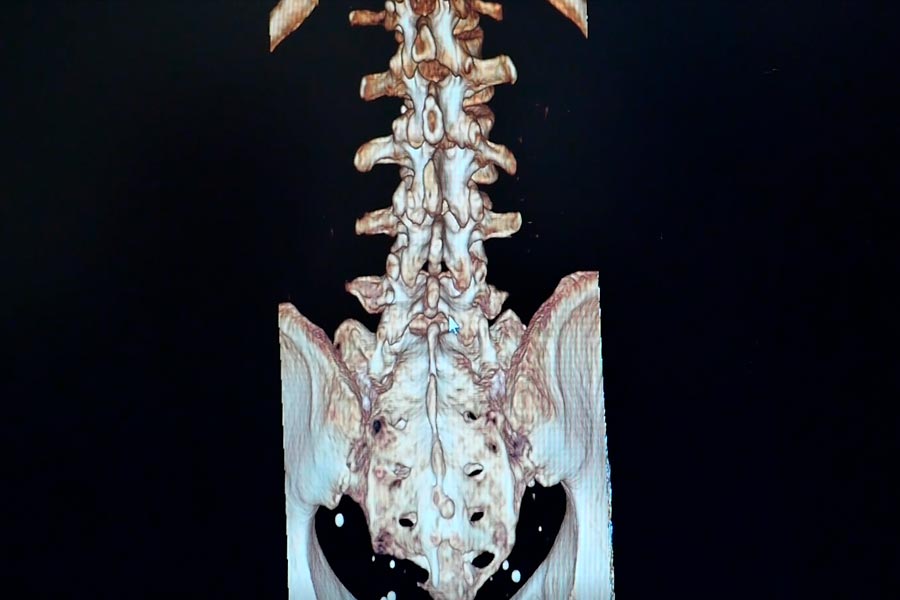 implante percutáneo hernia discasl l5s1