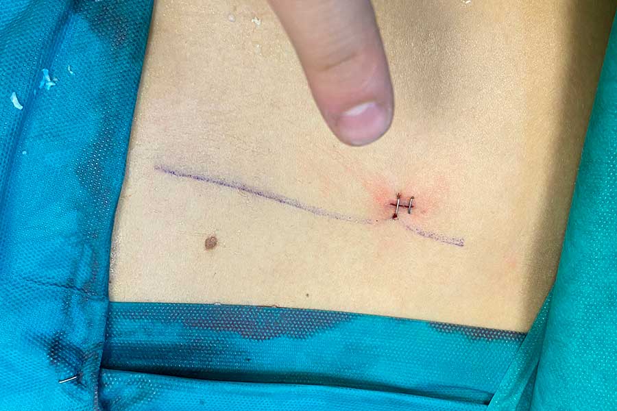 incision-minima-tras-cirugia-avanzada-de-columna