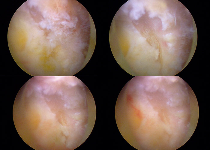 laminectomía-de-columna-en-madrid