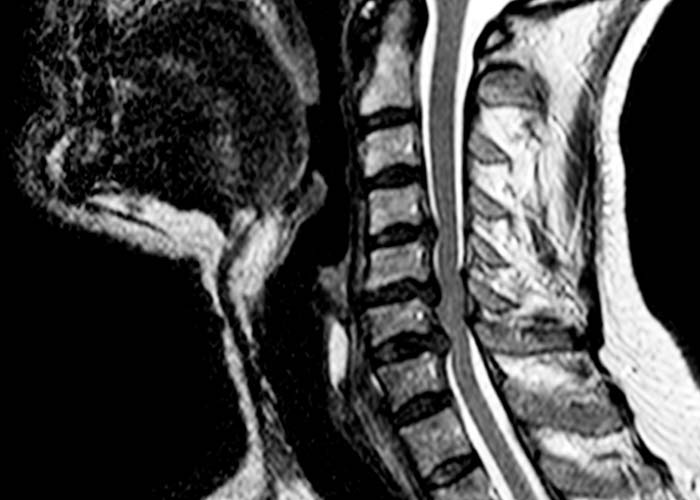 mielopatia-cirugia-de-columna-vertebral-en-madrid