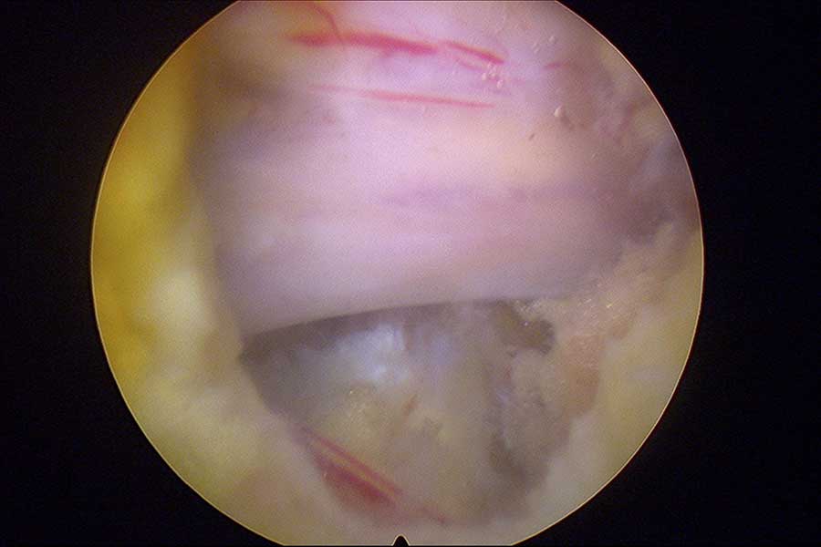 Nervio-amarillo-liberado
