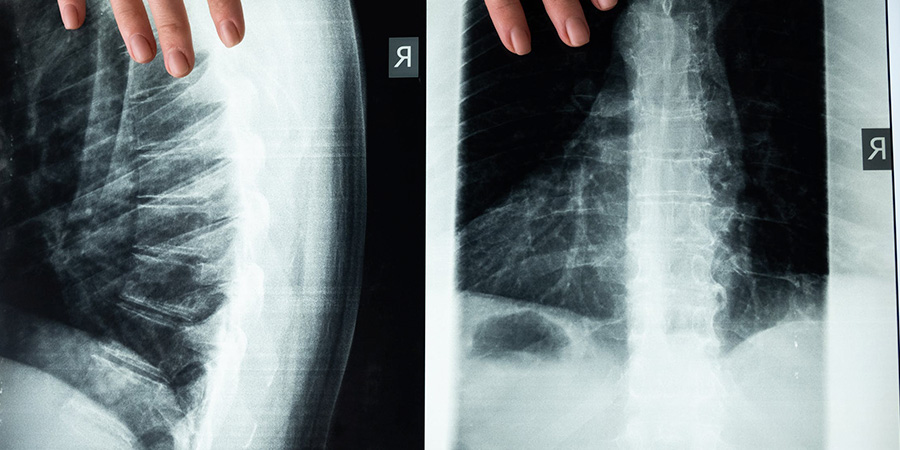 operacion de columna vertebral madrid