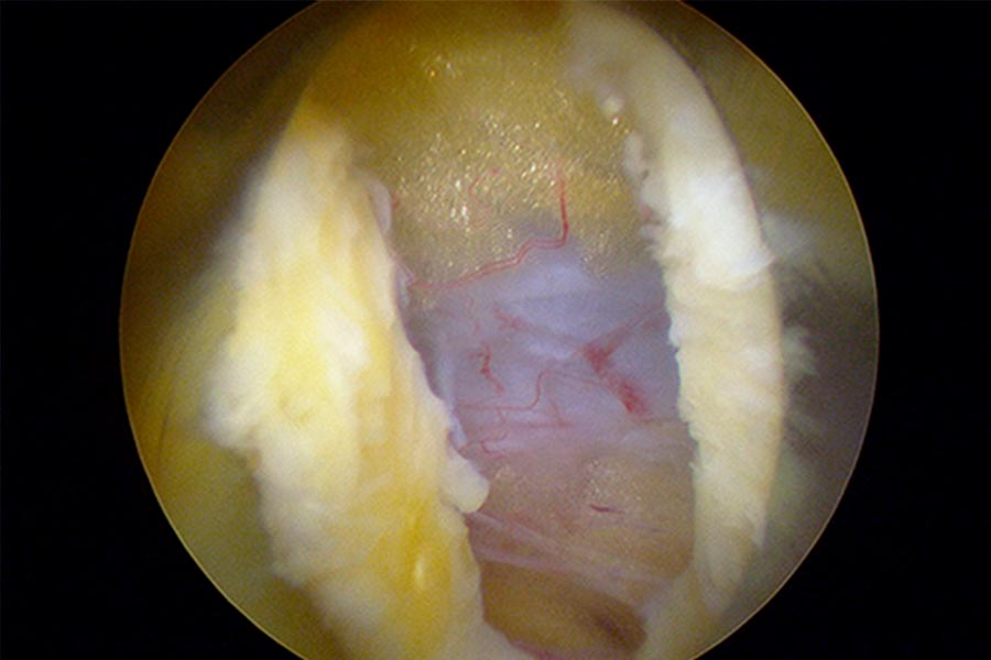 Operación hernia discal