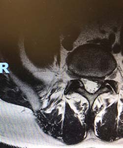 paciente-con-hermia-discal