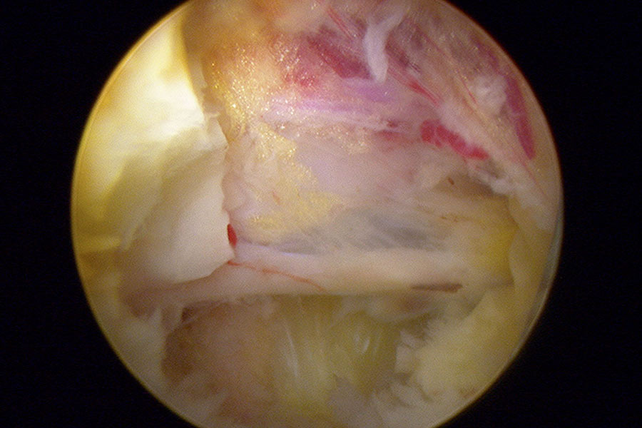 Hernia-discal-L5S1-mononivel