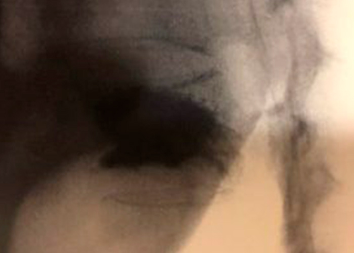 postoperatorio-cifoplastia-madrid