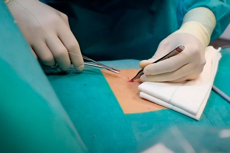 postoperatorio-estenosis-canal