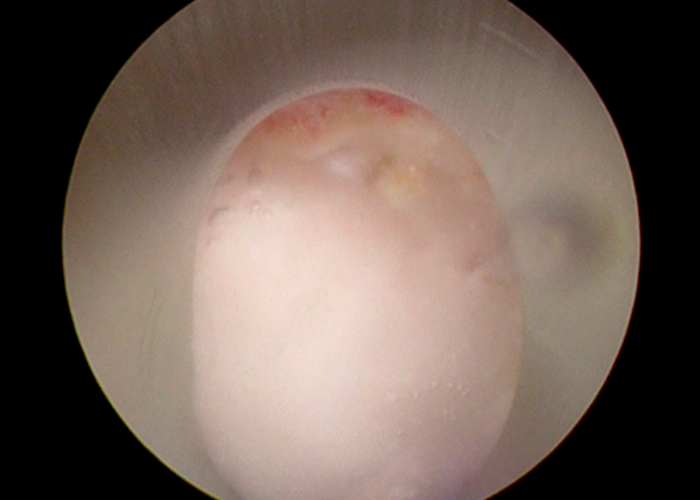 postoperatorio-estenosis-de-canal-instituto-CAC