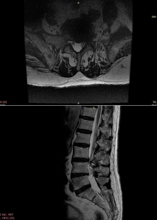 preoperatorio-estenosis-de-canal-instituto-cac