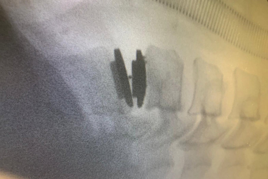 protesis-cervical-compleja-en-paciente-con-artrodesis